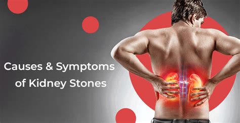 Kidney Stone Symptoms And Causes Mrmed