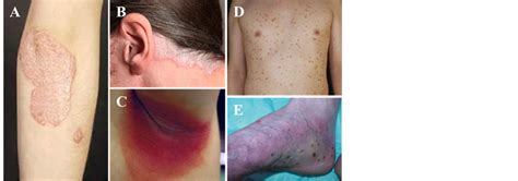 Plaque Psoriasis Understanding Risk Factors Of This Inflammatory Skin