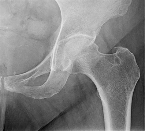Study Shows That High Bone Mineral Density Scores Are Associated With