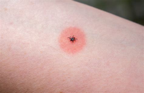 Tick Bite Pictures Symptoms What Does A Tick Bite Look