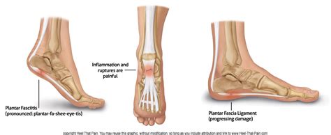 Plantar Fascial Thickening Prevention And Treatment Heel That Pain
