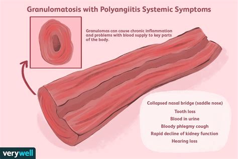 Diagnosing And Treating Granulomatosis With Polyangiitis