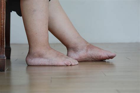Everything You Need To Know About Leg Swelling Yeg Fitness