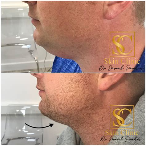 Aqualyx Fat Dissolving Injections Skin Clinic