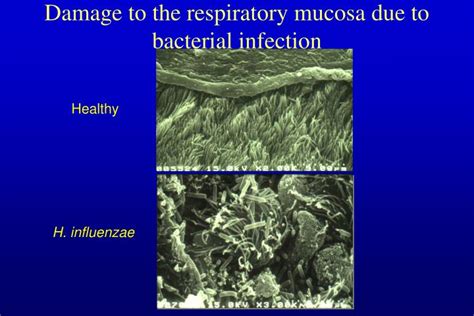 Mrsa As A Cause Of Lung Infection Including Airway