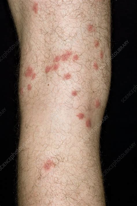 Allergy To Insect Bites On The Leg Stock Image C0072698 Science