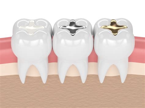 White Filings Vs Amalgam Fillings Which Are Best Shine Dental Group