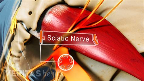 Types Of Sciatic Nerve Pain