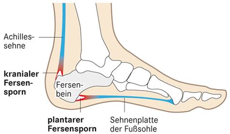 Ein stechen die fersen beim auftreten nach dem aufstehen oder nach längerem stehen? Was tun bei / gegen "Kranialer Fersensporn" ? (Gesundheit ...