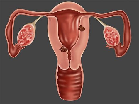 In Endometrial Cancer Lymphadenectomy Down Since 2007