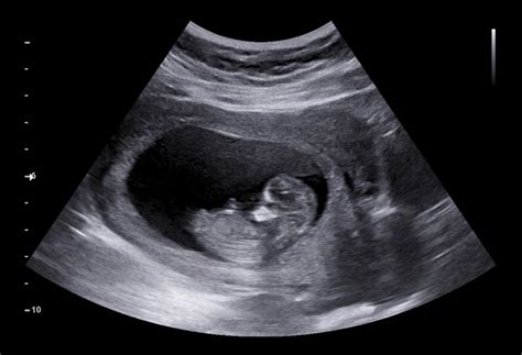 Us imaging uses sound waves to create an image. Early Pregnancy Ultrasound | Jewel Women's Center