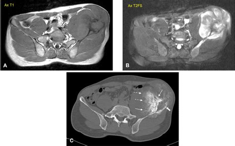 Low Grade Central Osteosarcoma Of Ilium A Case Report Asian Archives