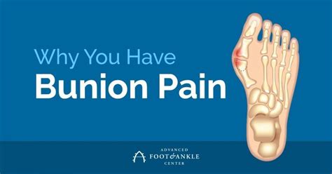 Why You Have Bunion Pain Advanced Foot And Ankle Center Podiatry