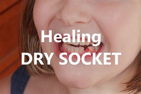 Healing Dry Socket Your Guide Dental Aware Australia