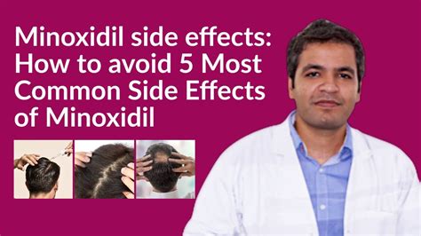Minoxidil Side Effects How To Avoid Minoxidil Side Effects 5 Common