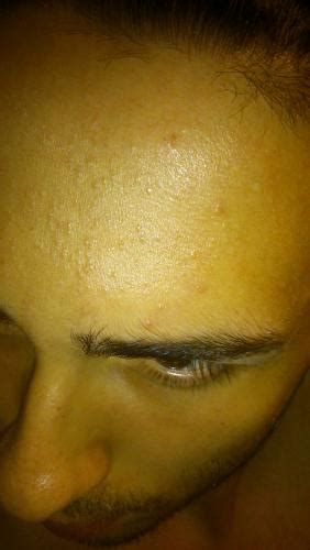 Flesh Coloured Bumps On Forehead Only Folliculitis Or Whiteheads