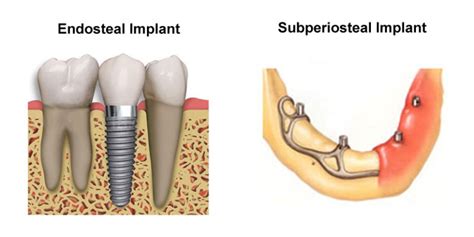 dental implant and how crucial replacing teeth elite dental care tracy elite dental care