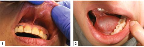 Racgp Common Causes Of Swelling In The Oral Cavity