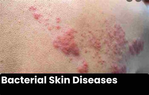 Skin Infections Types Introduction Types Side Effects And More