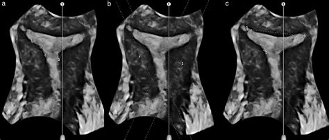 Congenital Uterine Malformation By Experts Cume Diagnostic Criteria For T‐shaped Uterus