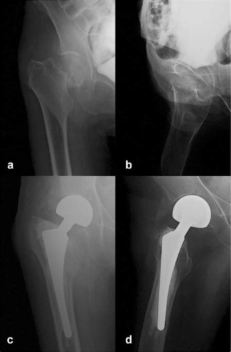 A D Radiographs At Time Of Diagnosis Of Femoral Neck Fracture Garden