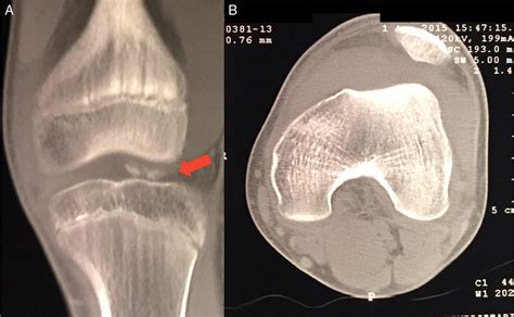 SciELO Brasil Femoral Condyle Osteochondral Fracture Treated With Bone Suture After Acute