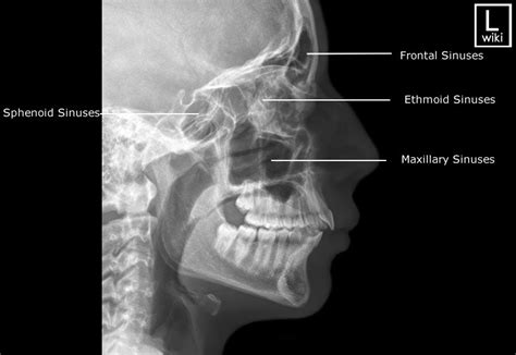Paranasal Sinuses Dental School Tech School Nursing School Radiology
