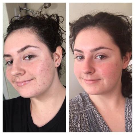 Two Chemical Peels Later Less Hyperpigmentation And Scarring Highly