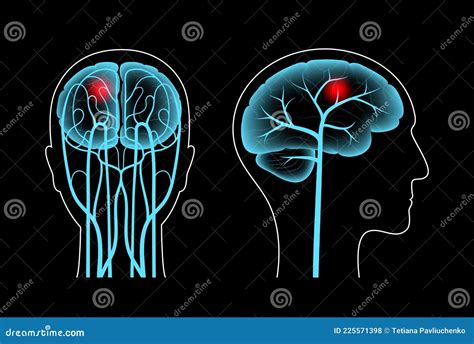 Hersenpijn Ziekte Vector Illustratie Illustration Of Hersenen 225571398