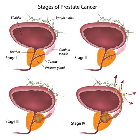 Prostate Cancer Stages University Health News