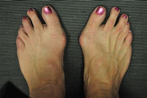 Bunions Discussed By A Podiatrist