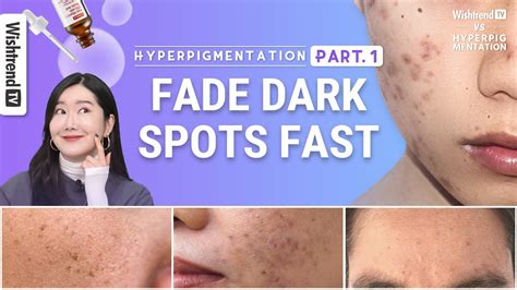 How To Get Rid Of Hyperpigmentation Brightening Skincare Routine