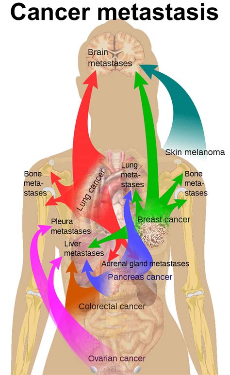 Cancer Metastasis Causes Symptoms And Metastasis Survival Rate
