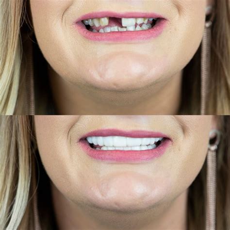 Platinum dual instasmile veneers in shade BL1. in 2020 ...