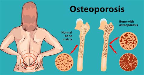 Osteoporosis Treatment: 13 Ways to Stop Bone Loss Before It's Too Late!