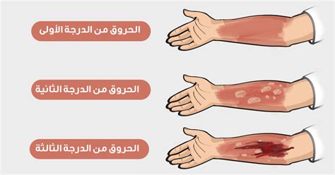 علاج الحروق الجلدية