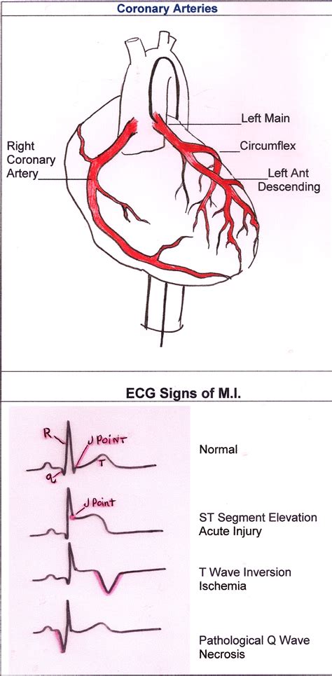 Ecg Localization Of Myocardial Infarction Ischemia And Images And
