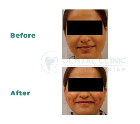 Dimple Creation Procedure Dr Puri Dentist