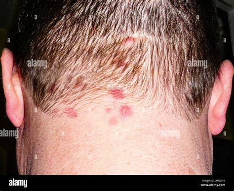 La Dermatite Herpétiforme Une Rare Maladie De Peau Subi Par Les