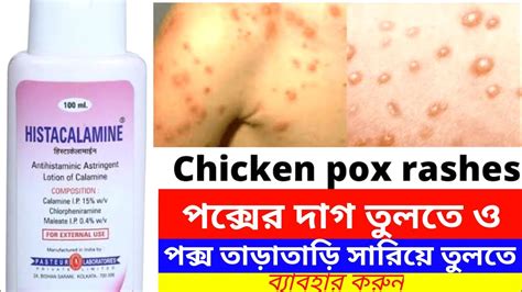 Histacalamine Lotion Uses In Bengali Calamine Lotion Uses For Chicken