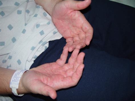 Genetic rashes, like eczema or psoriasis, appear because your skin or immune system is triggered to produce them. Chris' Mystery Allergic Reaction Rash