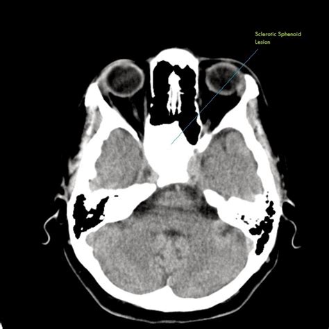 Ultimate Radiology : Case of the Day : Sclerotic Sphenoid ...