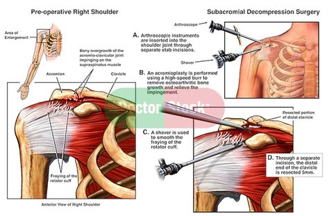 Shoulder Impingement Injury With Arthroscopic Surgery Doctor Stock