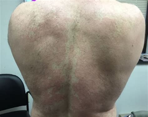 Clinical Challenge A Rash On The Back And Chest Mpr