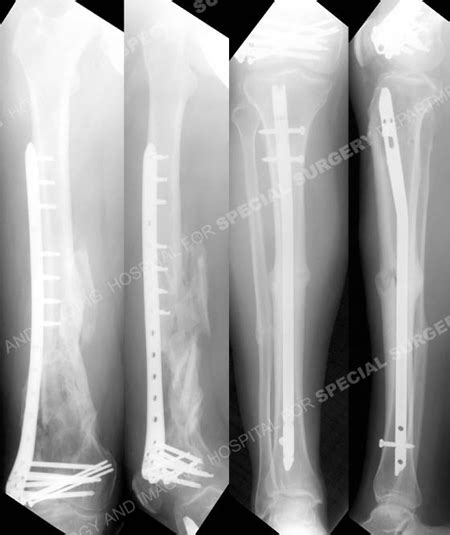 Compound Fracture Open Fracture Hss Orthopedic Trauma Service