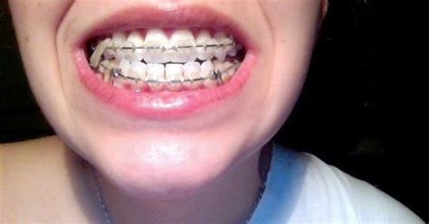 Jaw Surgery And Other Adventures Braces Pictures