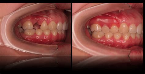 Partial Dentures Seasons Of Smiles Dental Arthur Norman Medina Dds
