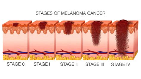 Signs And Symptoms And Photographs Of Stage 4 Melanoma More In Cancer A Z
