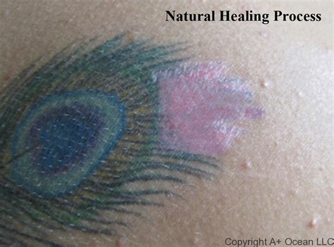 Gallery Aocean Natural Tattoo Removal Solution