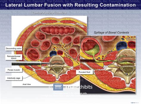 Lateral Lumbar Fusion With Resulting Contamination Trialexhibits Inc